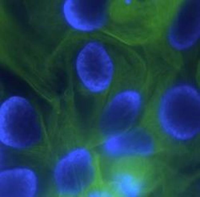 Каждая пятая женщина в Турции болеет раком молочной железы