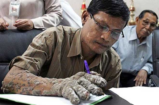 Врачи вылечили "человека-дерево"