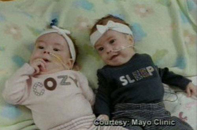 Американские сиамские близнецы – до и после (фотосессия)