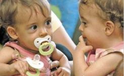 Американские сиамские близнецы – до и после (фотосессия)