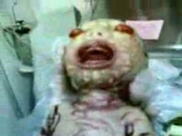 В Саудовской Аравии родился ребенок-змея с глазами наружу (фотосессия)