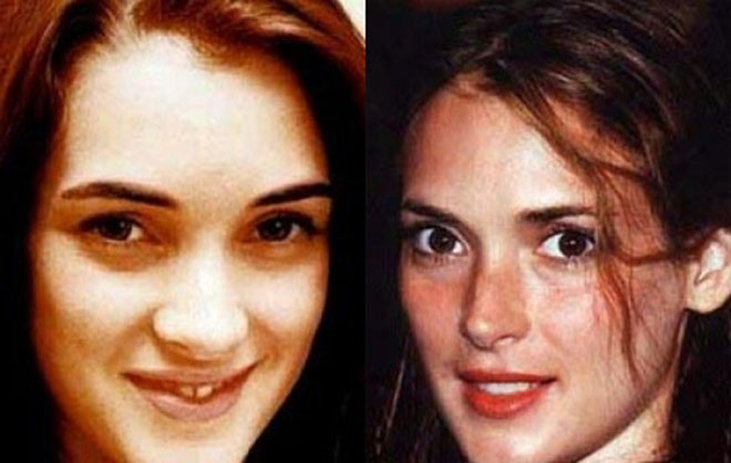 9 лучших исправленных звездных носов (фотосессия)