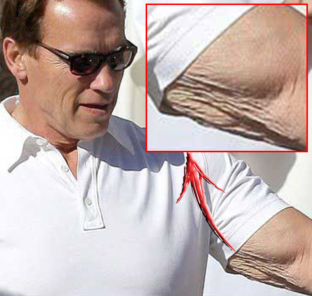 Арнольд Шварценеггер изуродовал себя