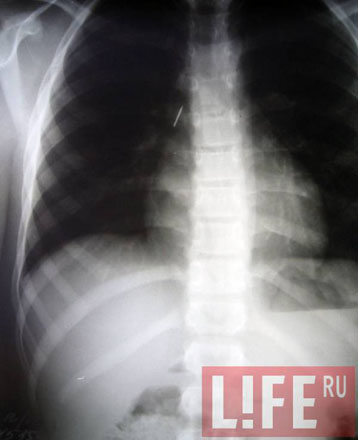 12-летний мальчик целый месяц прожил с раскрытой булавкой в бронхах