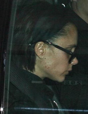 У Виктории Бекхэм проблемы с кожей