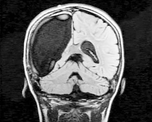 9-летней девочке из Бостона удалили половину мозга