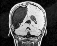 9-летней девочке из Бостона удалили половину мозга