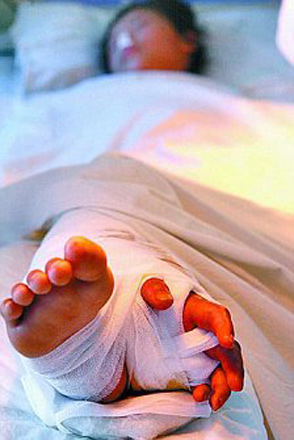 Девочке спасли руку, пришив ее к ноге