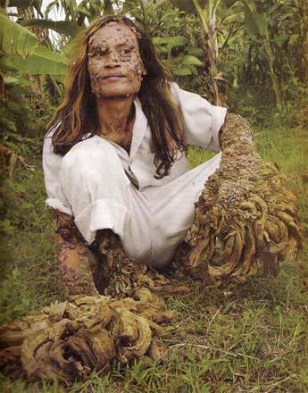 Люди с редкими заболеваниями (фотосессия)