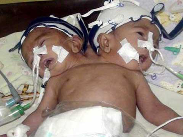 Люди с редкими заболеваниями (фотосессия)