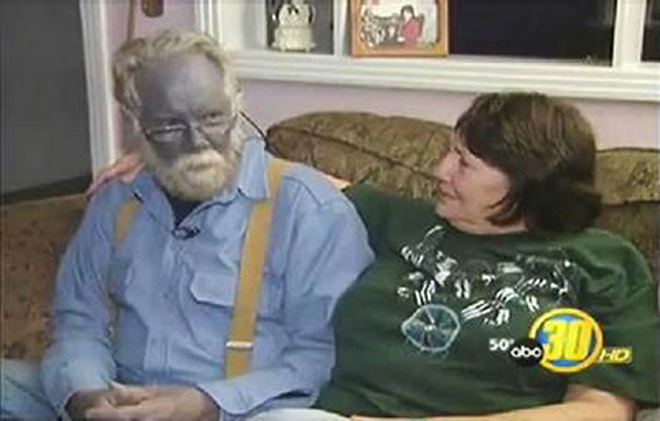 Люди с редкими заболеваниями (фотосессия)