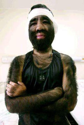 Люди с редкими заболеваниями (фотосессия)