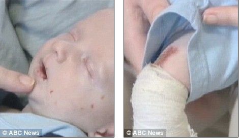 У ребенка на большей части тела нет кожи (фотосессия)