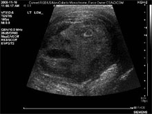 Врачи обнаружили опухоль, которая напоминает лицо человека