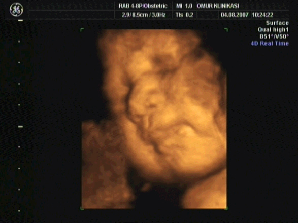 В чем особенность ультразвуковой диагностики 4D при беременности