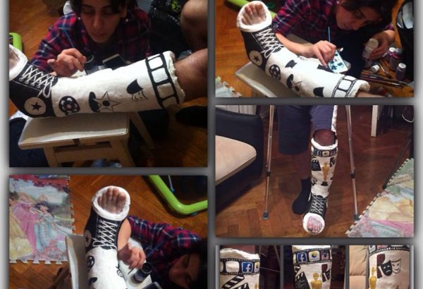 Нога в гипсе Эльнура Керимова стала креативным произведением (ФОТО)