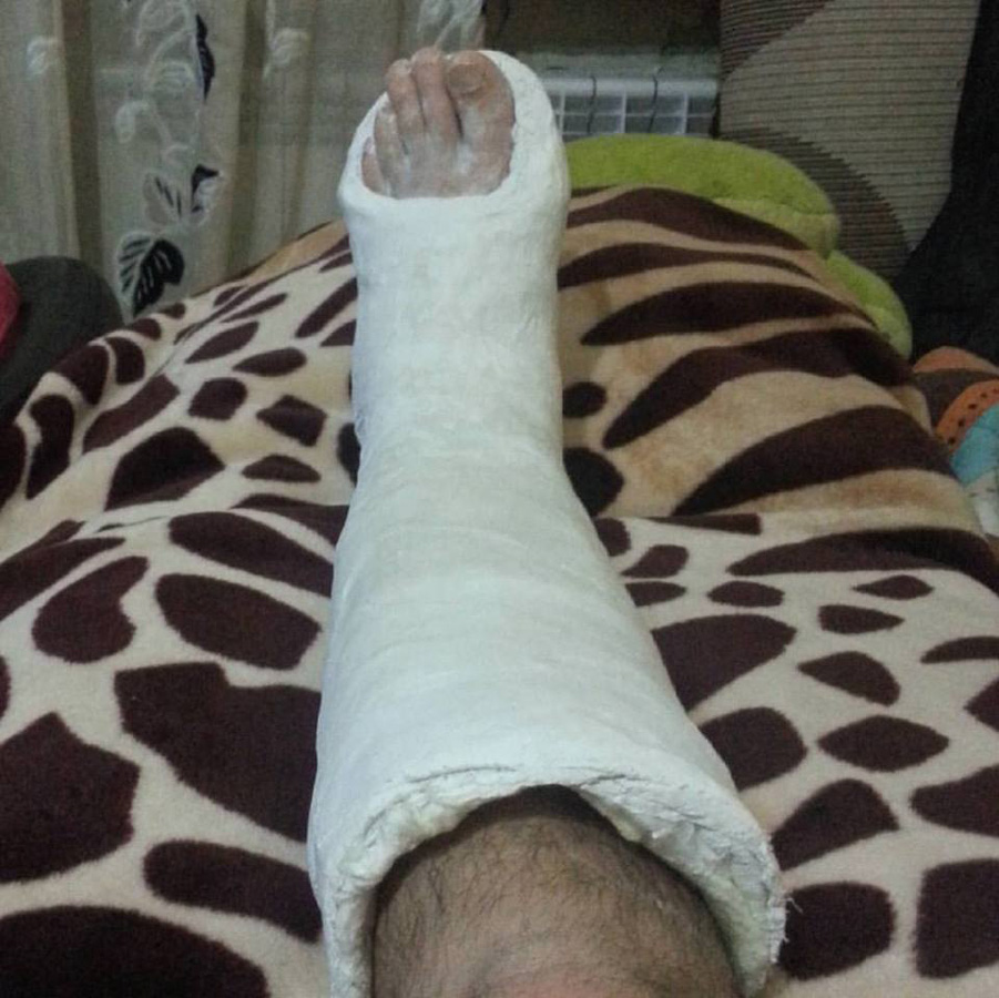 Нога в гипсе Эльнура Керимова стала креативным произведением (ФОТО)