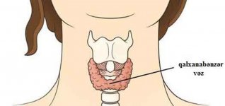 Почему возникает зоб – симптомы, лечение (ФОТО)
