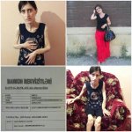 У Айшан врожденный синдром Маделунга – призыв о помощи (ФОТО)