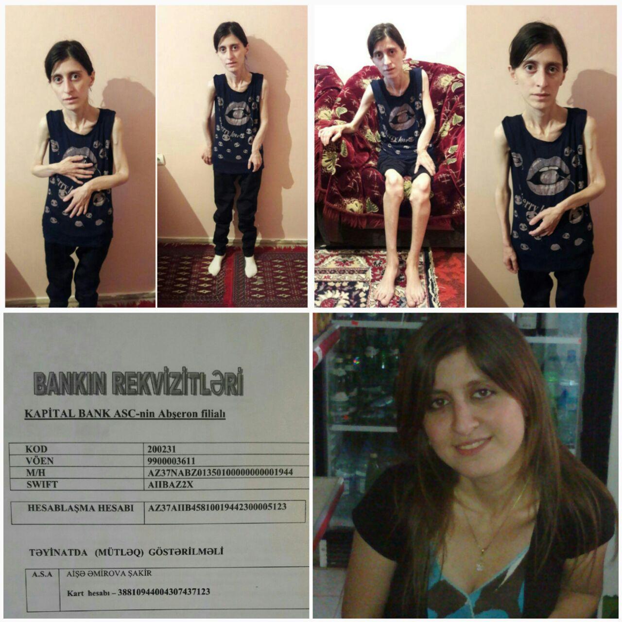 У Айшан врожденный синдром Маделунга – призыв о помощи (ФОТО)