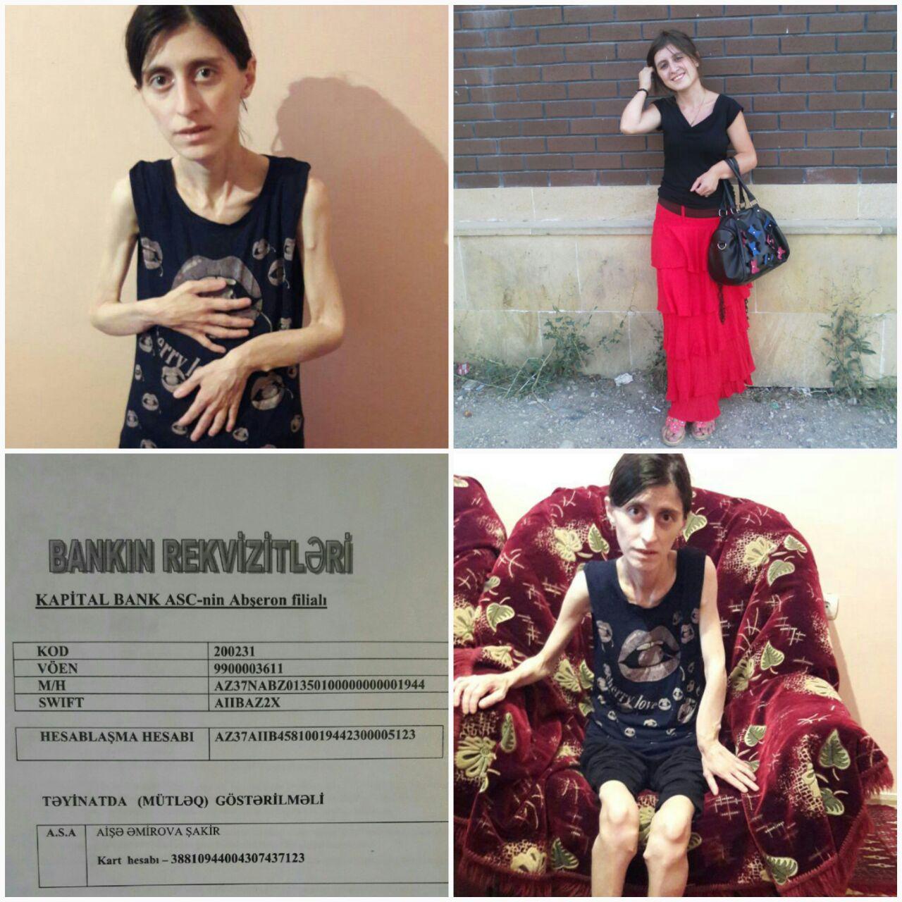 У Айшан врожденный синдром Маделунга – призыв о помощи (ФОТО)