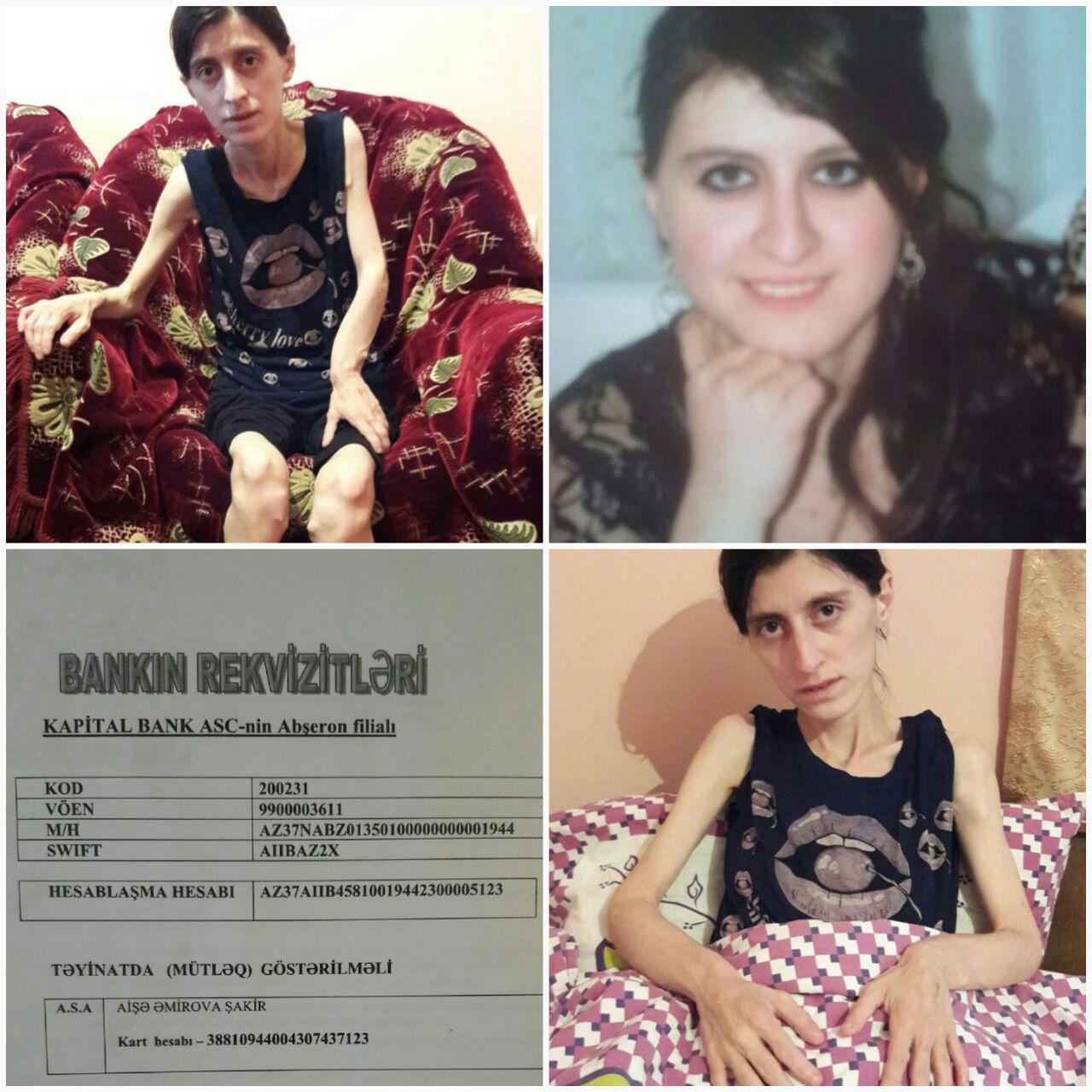 У Айшан врожденный синдром Маделунга – призыв о помощи (ФОТО)