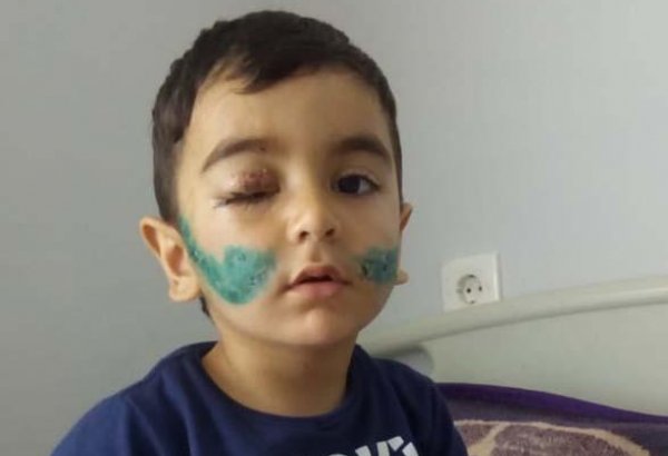 Мальчику, покусанному собакой в Баку, сняли швы, вакцинация продолжается - врач (ФОТО)