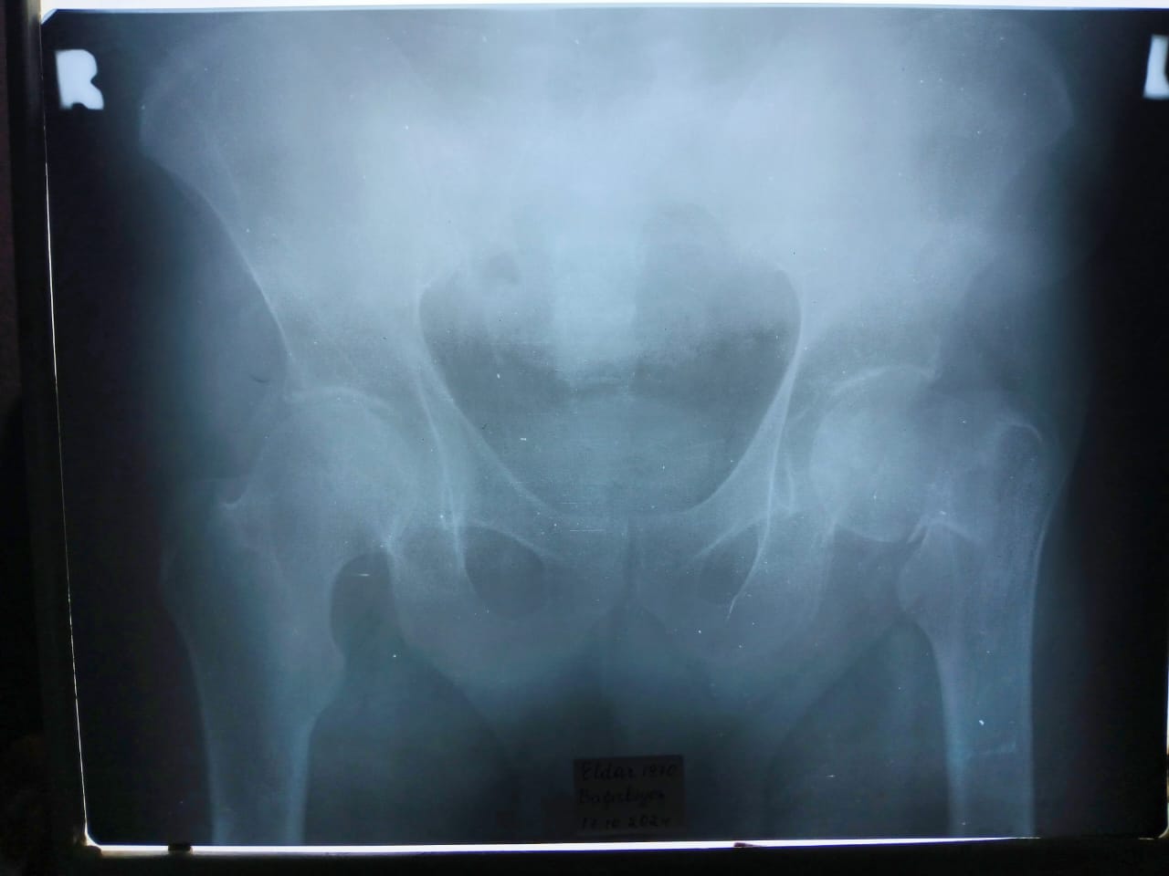 Госпитализирован актер Эльдар Багирбеков – из Хачмаза везут в Баку (ФОТО)