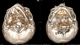 Уникальная 10-часовая операция от Министерства здравоохранения Азербайджана: пациенту была сформирована новая челюсть из собственной кости (ФОТО/ВИДЕО)