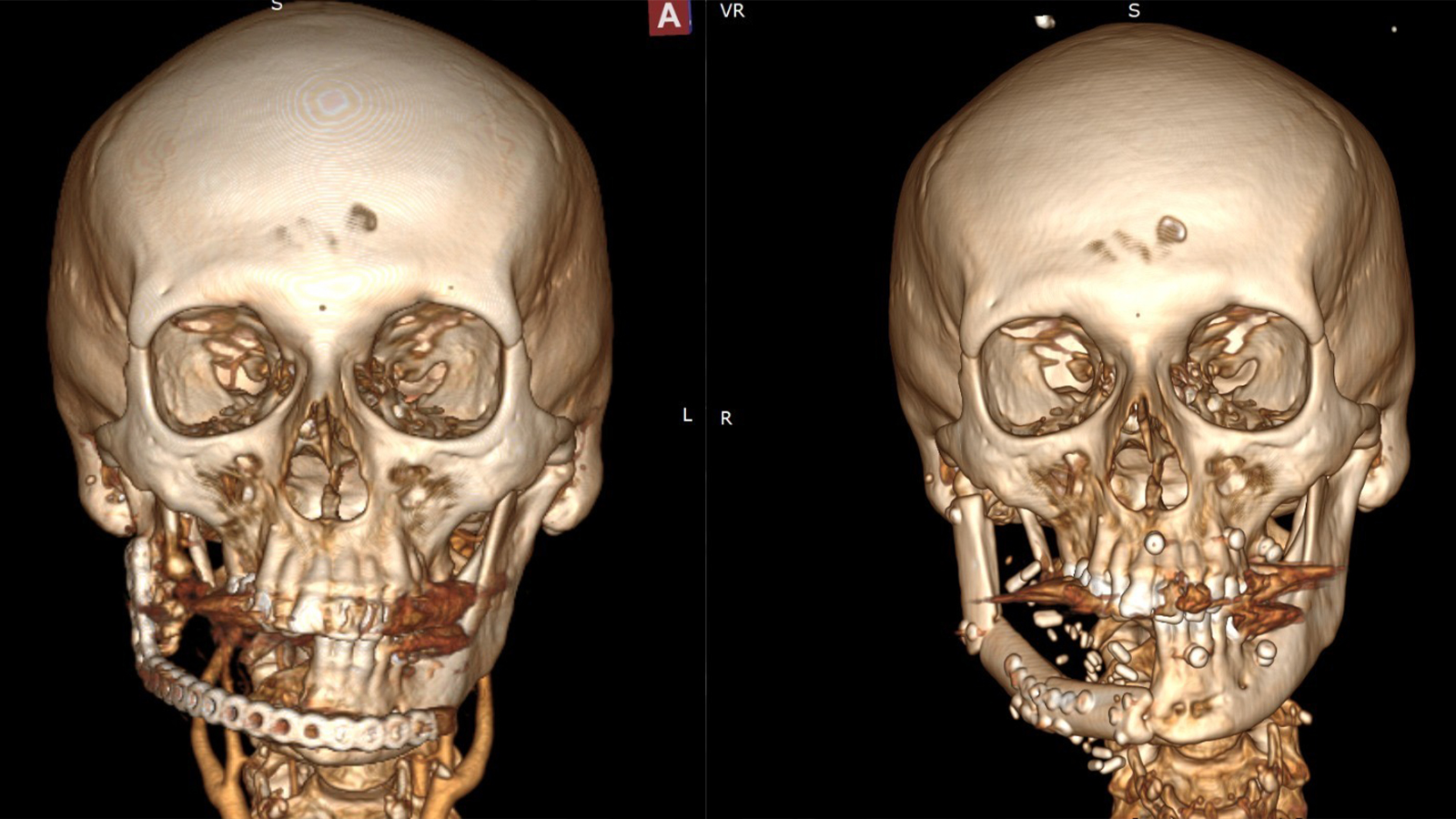 Уникальная 10-часовая операция от Министерства здравоохранения Азербайджана: пациенту была сформирована новая челюсть из собственной кости (ФОТО/ВИДЕО)