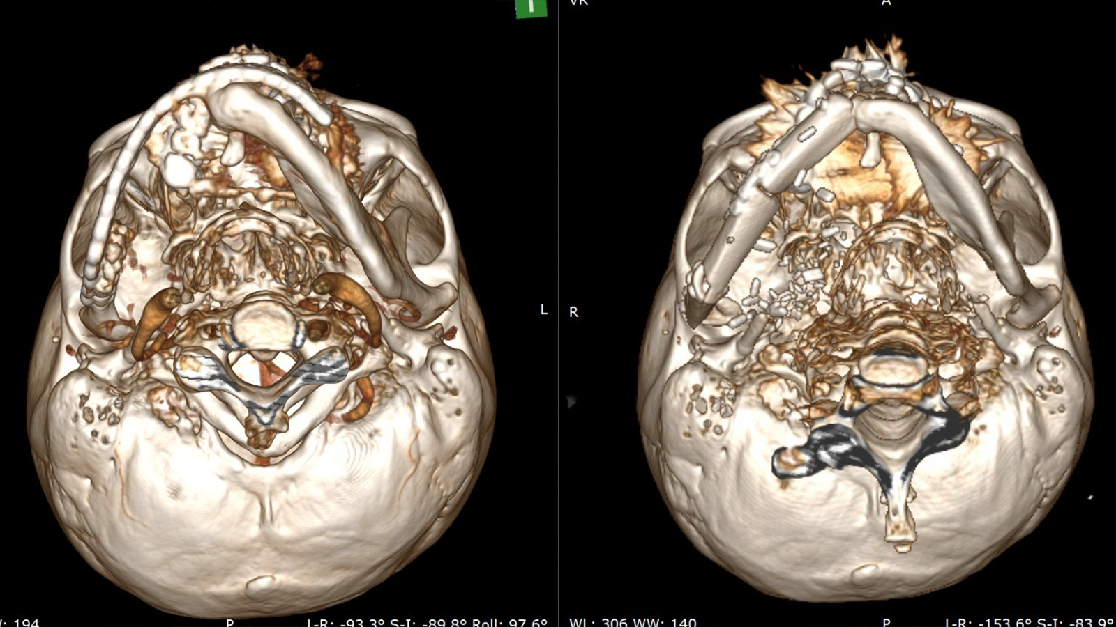 Уникальная 10-часовая операция от Министерства здравоохранения Азербайджана: пациенту была сформирована новая челюсть из собственной кости (ФОТО/ВИДЕО)